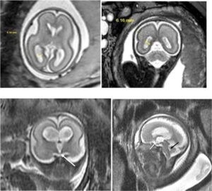 MRI thai