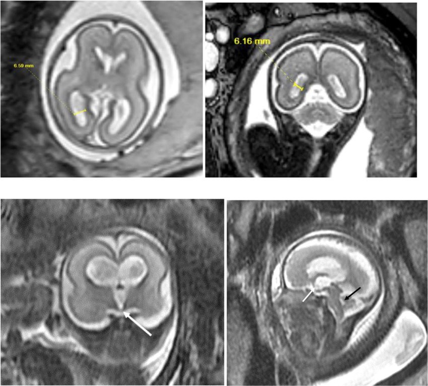 MRI thai