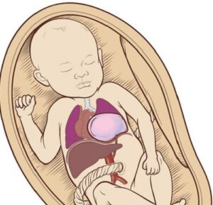 Minh họa thai nhi bị CPAM với khối tổn thương trong phổi gây chèn ép tim và trung thất trong buồng tử cung