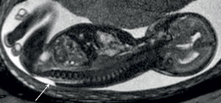 MRI phát hiện gì thêm trong giãn não thất
