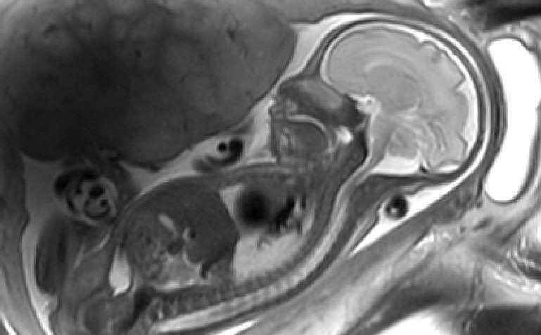 MRI thai trong giãn não thất
