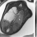 Hình ảnh MRI thai nhi cho thấy khối tổn thương dạng nang trong phổi, nghi CPAM hoặc phổi biệt lập với cấu trúc không đồng nhất