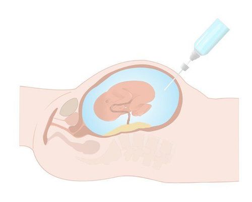 nguyên nhân giãn não thất.