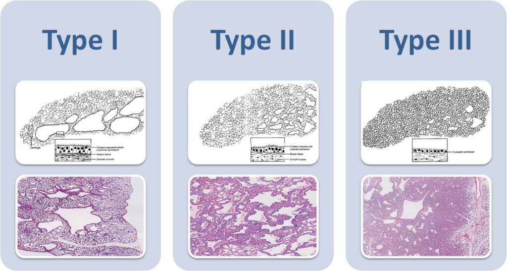 So sánh CPAM type 1, type 2 và type 3 với đặc điểm nang lớn, nang nhỏ và mô đặc trên mô học