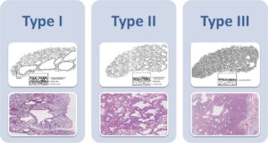 So sánh CPAM type 1, type 2 và type 3 với đặc điểm nang lớn, nang nhỏ và mô đặc trên mô học