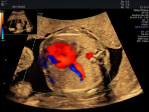 Siêu âm thai Doppler màu cho thấy khối phổi bất thường với tín hiệu mạch máu, gợi ý phân biệt CPAM với phổi biệt lập