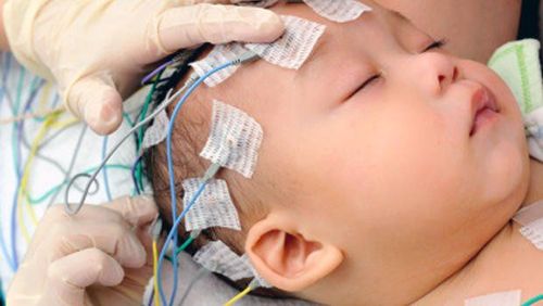 Tiên lượng khi bất thường rãnh Sylvius