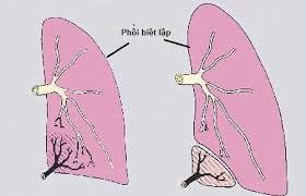 Sơ đồ phổi biệt lập cho thấy vùng nhu mô phổi không kết nối với hệ phế quản và được cấp máu từ động mạch hệ thống