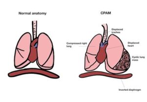 So sánh giải phẫu phổi bình thường và CPAM với khối nang gây chèn ép tim và lệch trung thất