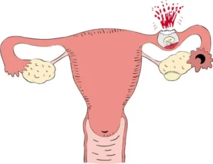 thai ngoài tử cung