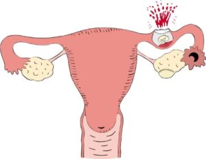 Thai ngoài tử cung vỡ có nguy hiểm không