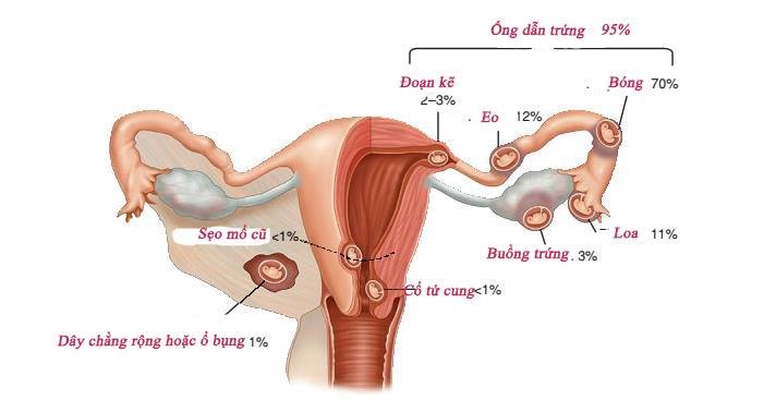 thai ngoài tử cung có giữ được không