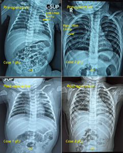 X-quang ngực trẻ sơ sinh trước và sau phẫu thuật CPAM cho thấy khối tổn thương phổi được loại bỏ và cải thiện thông khí