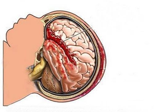 xuất huyết não gây giãn não thất thai nhi