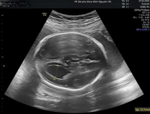 MRI phát hiện gì thêm trong giãn não thất