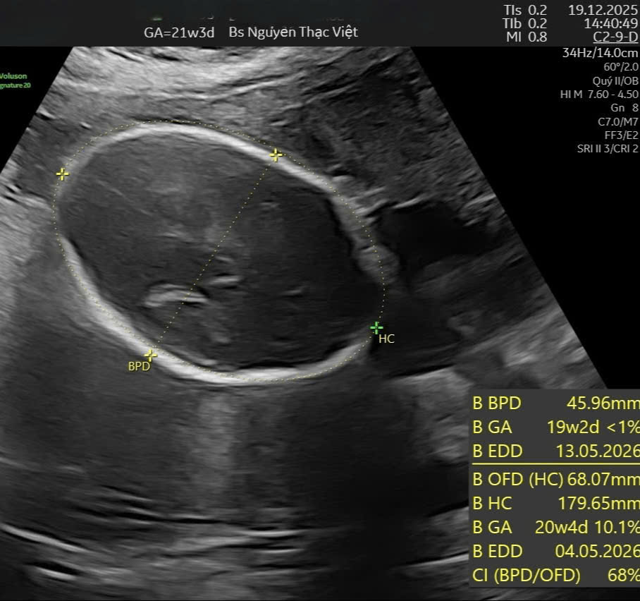 Siêu âm đầu nhỏ microcephaly thai nhi — đo chu vi vòng đầu nhỏ hơn tuổi thai