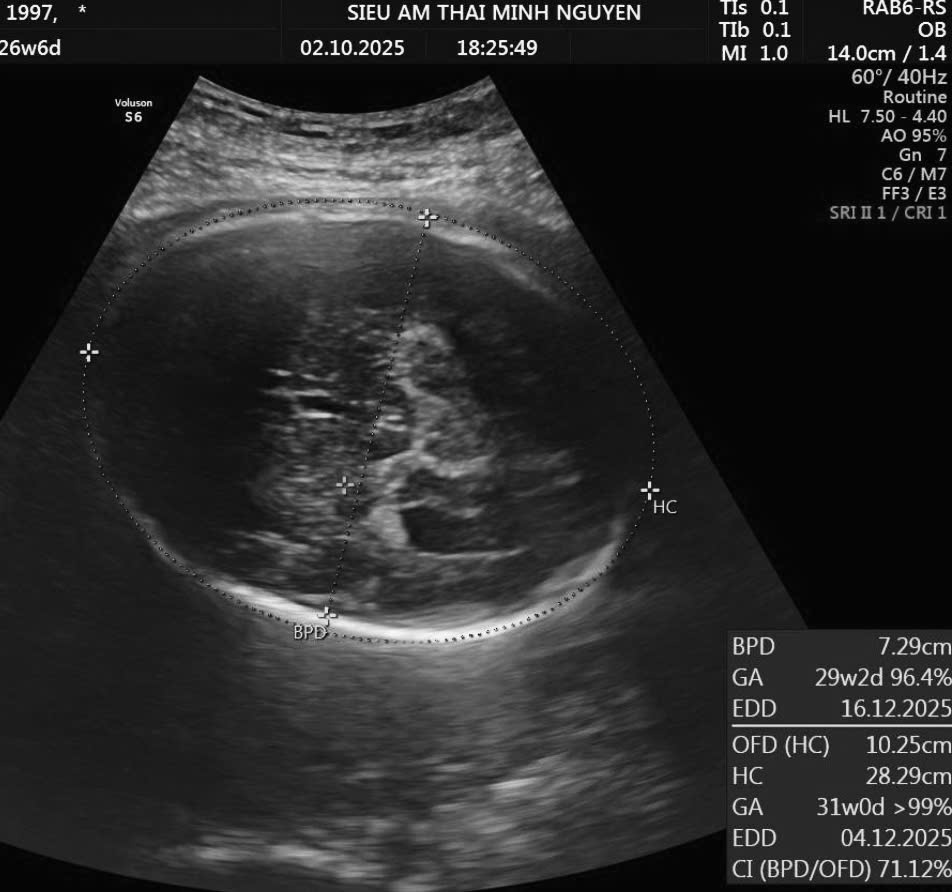 Đầu to macrocephaly thai nhi với kích thước hộp sọ và chu vi vòng đầu lớn hơn tuổi thai