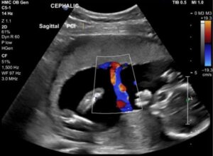 Doppler động mạch rốn trong thai chậm tăng trưởng