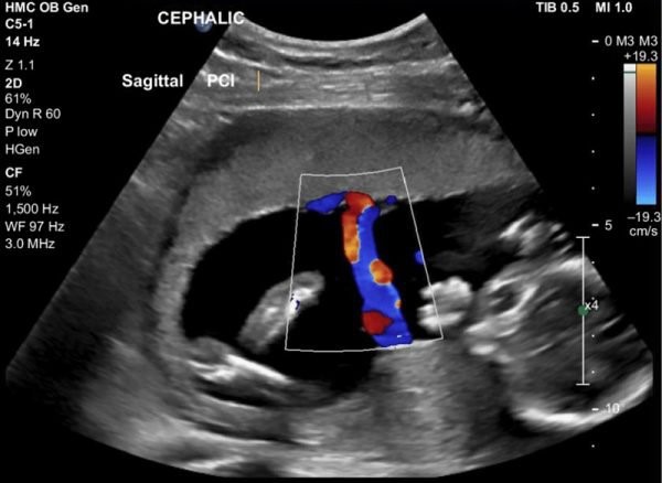 Doppler động mạch rốn trong thai chậm tăng trưởng