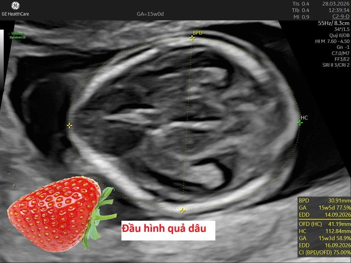 Hình ảnh siêu âm đầu quả dâu ở thai nhi nghi trisomy 18, một dấu hiệu gợi ý hội chứng Edwards.