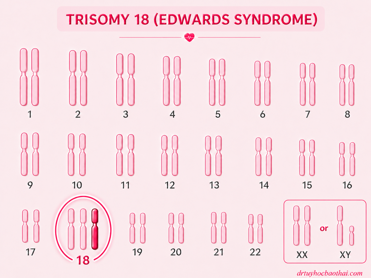 Hình minh họa karyotype trisomy 18 với một nhiễm sắc thể 18 dư ra được tô đậm, đặc trưng cho hội chứng Edwards.