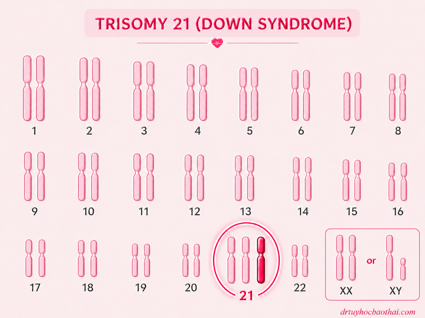 Hình minh họa karyotype trisomy 21 với một nhiễm sắc thể 21 dư ra được tô đậm, đặc trưng cho hội chứng Down.