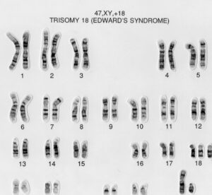 Karyotype trisomy 18 — bộ nhiễm sắc thể 47 XX/XY +18 chẩn đoán hội chứng Edwards