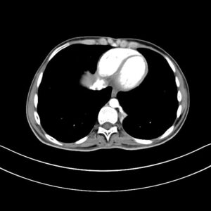 MRI thai nhi trong đánh giá phổi biệt lập