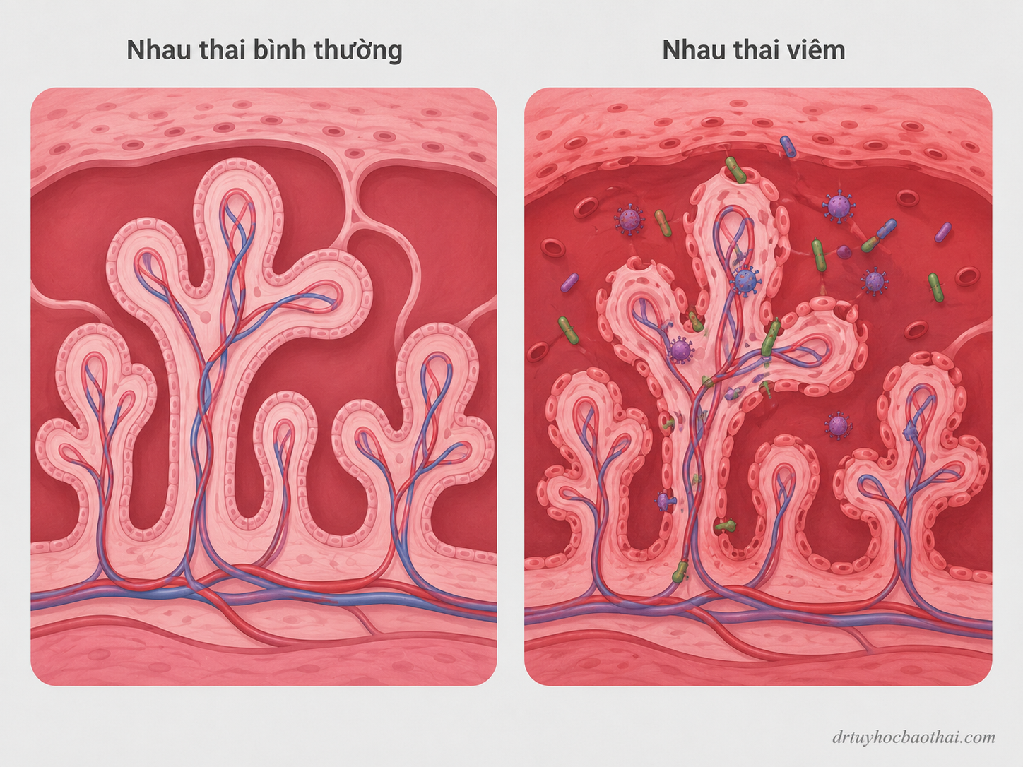 Nhiễm trùng bào thai