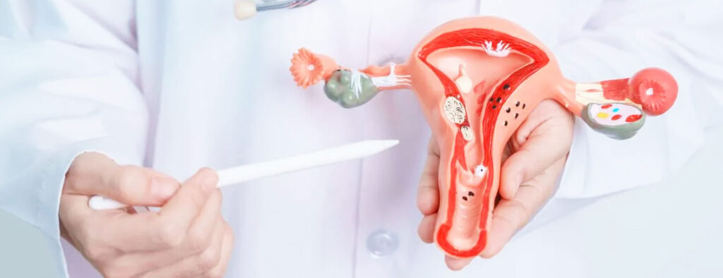 PCOS và sẩy thai liên tiếp