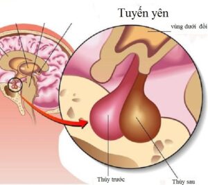 bất thường hố sau và tuyến yên