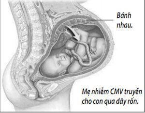 Thai chậm tăng trưởng do nhiễm trùng bào thai