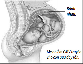 Thai chậm tăng trưởng do nhiễm trùng bào thai