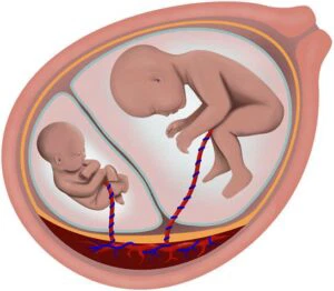 Thai chậm tăng trưởng khi nào cần sinh