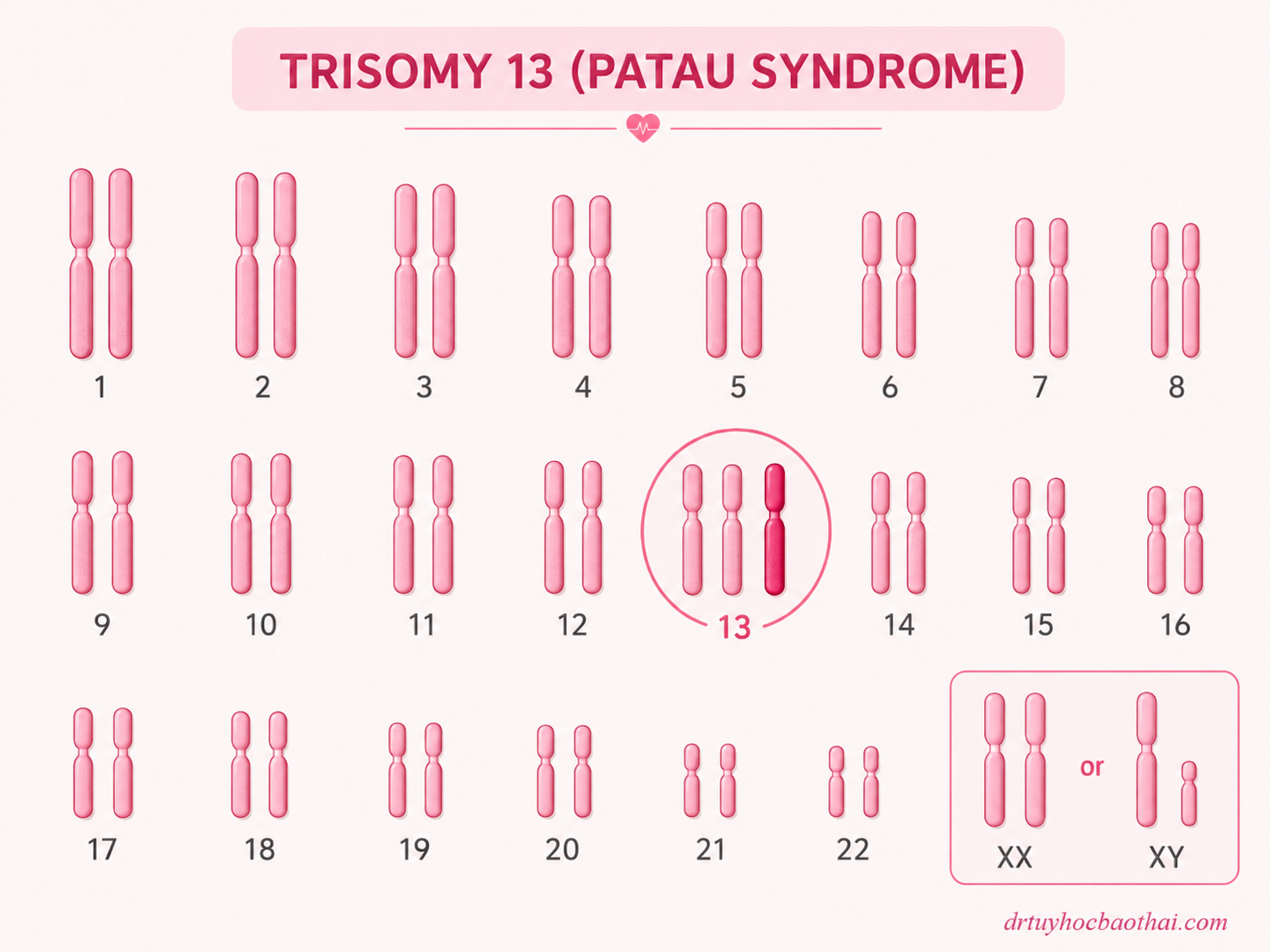 Hình minh họa karyotype trisomy 13 với một nhiễm sắc thể 13 dư ra được tô đậm, đặc trưng cho hội chứng Patau.