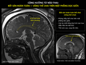 Hình ảnh MRI não thai cho thấy bất sản hoàn toàn thể chai trên mặt phẳng dọc giữa, không thấy thể chai và các sợi chất trắng tỏa hình nan hoa