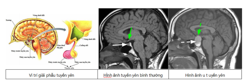 bất thường hố sau và tuyến yên