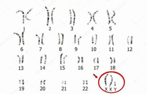 Hình ảnh bộ nhiễm sắc thể người cho thấy bất thường thừa nhiễm sắc thể 21 trong hội chứng Down