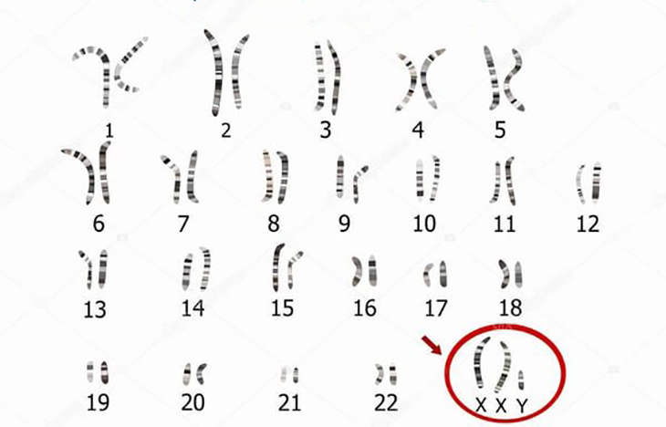 Hình ảnh bộ nhiễm sắc thể người cho thấy bất thường thừa nhiễm sắc thể 21 trong hội chứng Down
