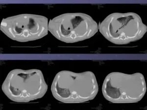 Hình ảnh CT lồng ngực các lát cắt ngang cho thấy khối phổi biệt lập ở vùng đáy phổi, giúp đánh giá cấu trúc và vị trí tổn thương