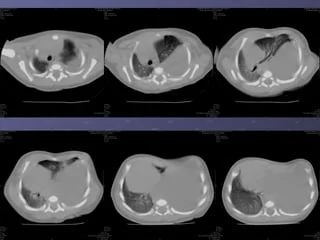 Hình ảnh CT lồng ngực các lát cắt ngang cho thấy khối phổi biệt lập ở vùng đáy phổi, giúp đánh giá cấu trúc và vị trí tổn thương