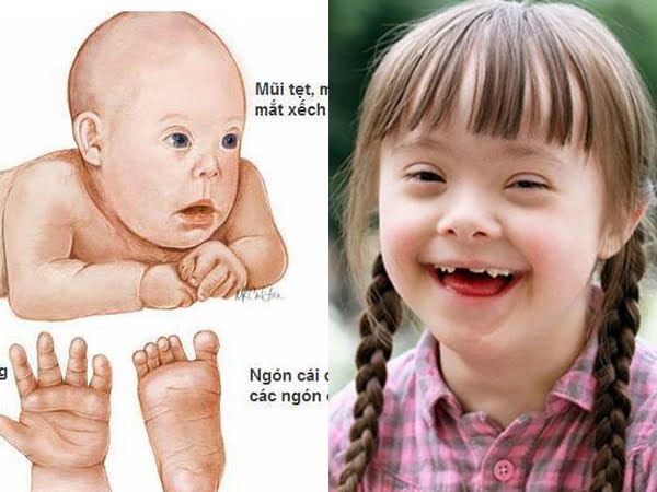 Hình ảnh trẻ mắc hội chứng Down với đặc điểm khuôn mặt điển hình như mắt xếch, sống mũi thấp và nếp gấp lòng bàn tay