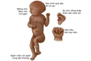 Hình ảnh minh họa các đặc điểm hình thái điển hình của trẻ mắc hội chứng Edwards như bàn tay nắm chặt, tai thấp và đầu nhỏ