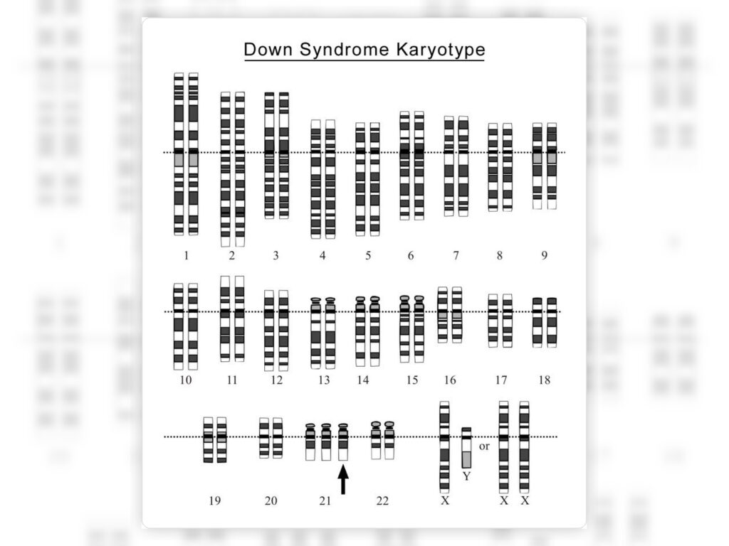 Karyotype hội chứng Down với ba nhiễm sắc thể số 21, gợi ý trisomy 21 ở thai nhi