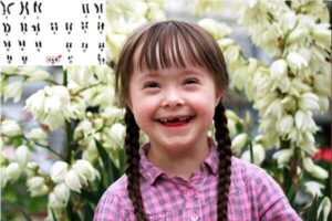 Hình ảnh trẻ mắc hội chứng Down với đặc điểm khuôn mặt điển hình, kèm hình minh họa nhiễm sắc thể 21 thừa