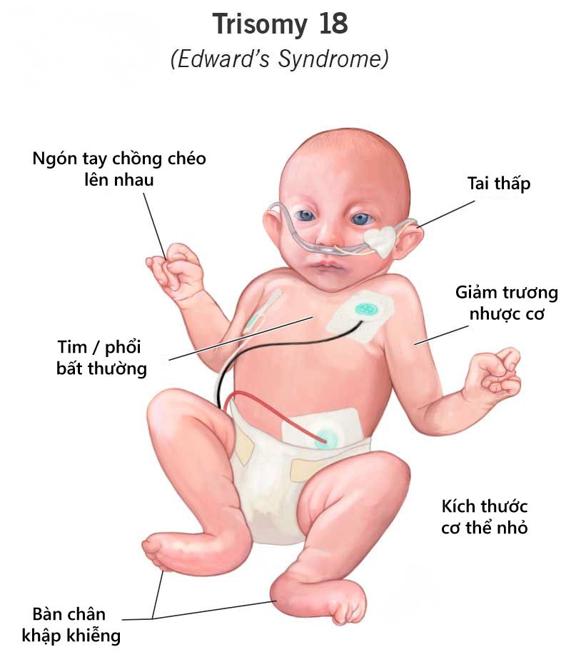 Hình minh họa hội chứng Edwards (trisomy 18) với các đặc điểm điển hình như bàn tay nắm chặt, dị tật tim và chậm phát triển