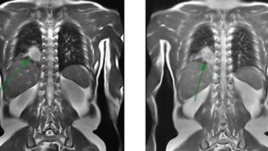 mri-thai-nhi-phat-hien-phoi-biet-lap-coronal.png