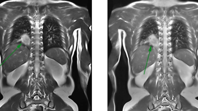mri-thai-nhi-phat-hien-phoi-biet-lap-coronal.png