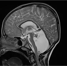 pontocerebellar hypoplasia