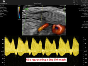 Siêu âm Doppler ống tĩnh mạch thai nhi — đảo ngược sóng a tuần 15, dấu hiệu suy tâm thất phải